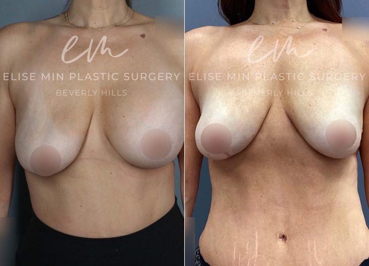 This 48-year-old patient had saline breast implants placed over a decade ago and recently experienced a spontaneous rupture of the right implant, further worsening her breast asymmetry. She came to our office wanting to remove her implants and restore a natural, symmetrical breast shape without replacement. She also noted that her breasts had been asymmetrical even before the rupture. To better assess the asymmetry and plan her surgery, we first deflated the left saline implant in clinic. Few weeks later, she underwent implant removal and capsulectomy, followed by fat grafting to both breasts to restore volume and shape. Additionally, a gentle breast lift procedure was performed on the right breast to achieve better symmetry with the left. She is thrilled with her results—her breasts now feel lighter, more natural, and beautifully balanced.