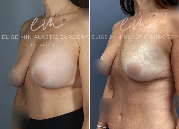 This 48-year-old patient had saline breast implants placed over a decade ago and recently experienced a spontaneous rupture of the right implant, further worsening her breast asymmetry. She came to our office wanting to remove her implants and restore a natural, symmetrical breast shape without replacement. She also noted that her breasts had been asymmetrical even before the rupture. To better assess the asymmetry and plan her surgery, we first deflated the left saline implant in clinic. Few weeks later, she underwent implant removal and capsulectomy, followed by fat grafting to both breasts to restore volume and shape. Additionally, a gentle breast lift procedure was performed on the right breast to achieve better symmetry with the left. She is thrilled with her results—her breasts now feel lighter, more natural, and beautifully balanced.