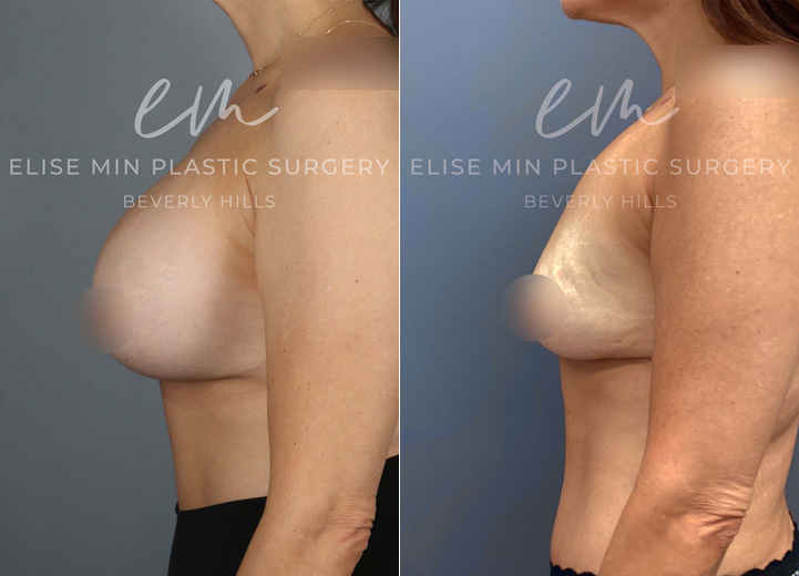 This 48-year-old patient had saline breast implants placed over a decade ago and recently experienced a spontaneous rupture of the right implant, further worsening her breast asymmetry. She came to our office wanting to remove her implants and restore a natural, symmetrical breast shape without replacement. She also noted that her breasts had been asymmetrical even before the rupture. To better assess the asymmetry and plan her surgery, we first deflated the left saline implant in clinic. Few weeks later, she underwent implant removal and capsulectomy, followed by fat grafting to both breasts to restore volume and shape. Additionally, a gentle breast lift procedure was performed on the right breast to achieve better symmetry with the left. She is thrilled with her results—her breasts now feel lighter, more natural, and beautifully balanced.