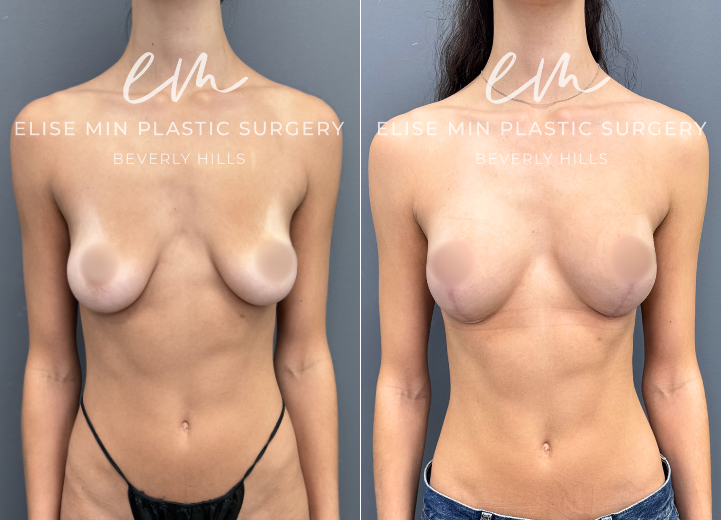 22 year old. 

Preop- b cup sized breasts. Happy with volume but with small weight loss, breast shapes changed and would like more fullness on the superior pole. Does not want to be bigger than a C cup. 

Postop-C cup. 

For this patient, fat transfer would not have given the look she wants although the volume increase from B to a small C cup can be attained through fat transfer alone. So the smallest implant (SSLP 125) was added for the superior pole why doing a lift was perfect for her. She also had her implants placed under the muscle for total pectoral coverage ( not dual-plane) to minimize risk for malpositioning or drop over the years without having to use additional mesh for the same purpose. Patient is now a very happy small C cup. 