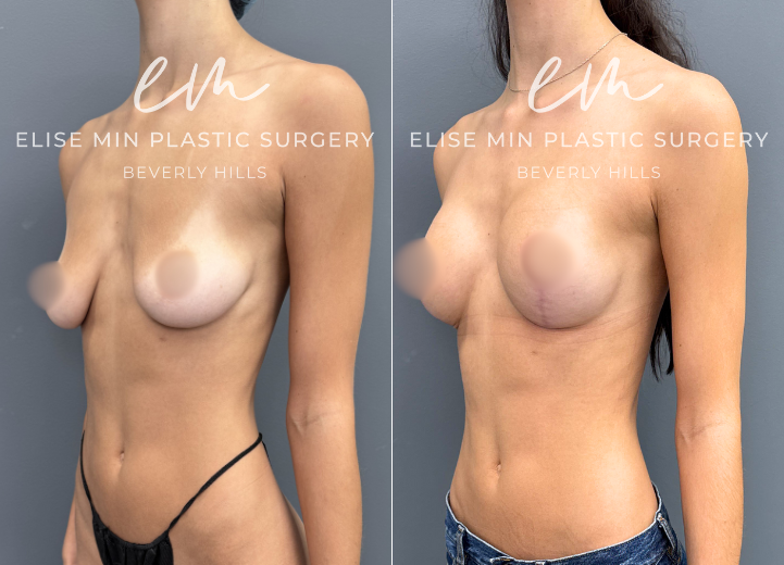 22 year old. 

Preop- b cup sized breasts. Happy with volume but with small weight loss, breast shapes changed and would like more fullness on the superior pole. Does not want to be bigger than a C cup. 

Postop-C cup. 

For this patient, fat transfer would not have given the look she wants although the volume increase from B to a small C cup can be attained through fat transfer alone. So the smallest implant (SSLP 125) was added for the superior pole why doing a lift was perfect for her. She also had her implants placed under the muscle for total pectoral coverage ( not dual-plane) to minimize risk for malpositioning or drop over the years without having to use additional mesh for the same purpose. Patient is now a very happy small C cup. 