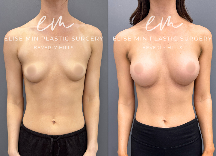 Breast augmentation with Motiva 340cc demi (“moderate”) profile silicone breast implants 

30 year old ERSD340  

Went from less than A cup to now a C cup. Loves how she looks in her bikinis. 