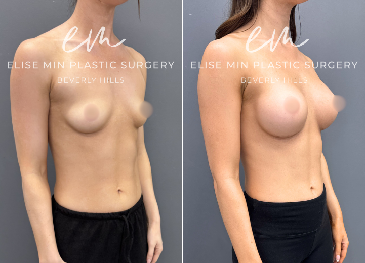 Breast augmentation with Motiva 340cc demi (“moderate”) profile silicone breast implants 

30 year old ERSD340  

Went from less than A cup to now a C cup. Loves how she looks in her bikinis. 