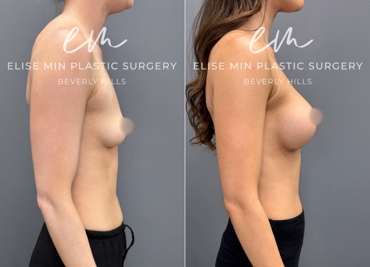 Breast augmentation with Motiva 340cc demi (“moderate”) profile silicone breast implants 

30 year old ERSD340  

Went from less than A cup to now a C cup. Loves how she looks in her bikinis. 