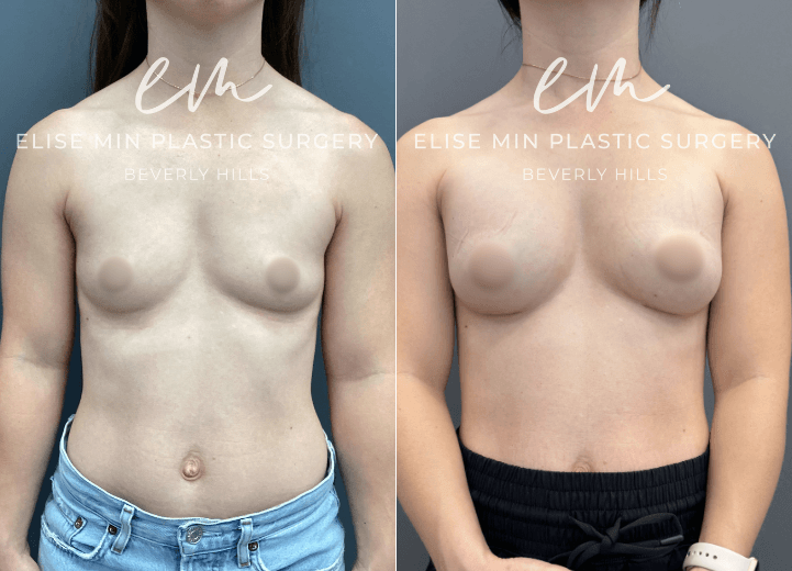Breast Augmentation - This 35-year-old woman desired greater breast volume while maintaining a natural, feminine appearance. Her surgical plan was guided by the MinLine™ Philosophy, an individualized approach focused on creating beautiful, proportional breasts while prioritizing shape, long-term support, and safety. She underwent placement of 220cc Natrelle Soft Touch silicone breast implants in a submuscular position to achieve her desired enhancement while maintaining proportion to her frame.