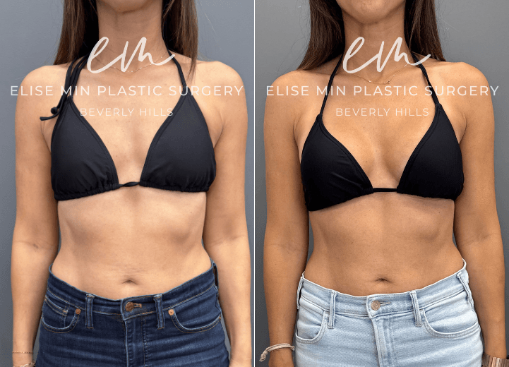 Breast augmentation with Motiva Ergonomix Mini Profile 220cc silicone breast implants - This 40-year-old patient wanted a subtle but meaningful enhancement to better complement her frame. Following breast augmentation with Motiva ERSM-220 implants, she went from an A cup to a C cup and now enjoys fuller, more balanced proportions with beautiful confidence in swimwear and everyday clothing.