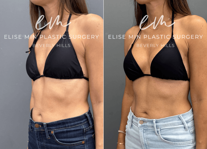 Breast augmentation with Motiva Ergonomix Mini Profile 220cc silicone breast implants - This 40-year-old patient wanted a subtle but meaningful enhancement to better complement her frame. Following breast augmentation with Motiva ERSM-220 implants, she went from an A cup to a C cup and now enjoys fuller, more balanced proportions with beautiful confidence in swimwear and everyday clothing.