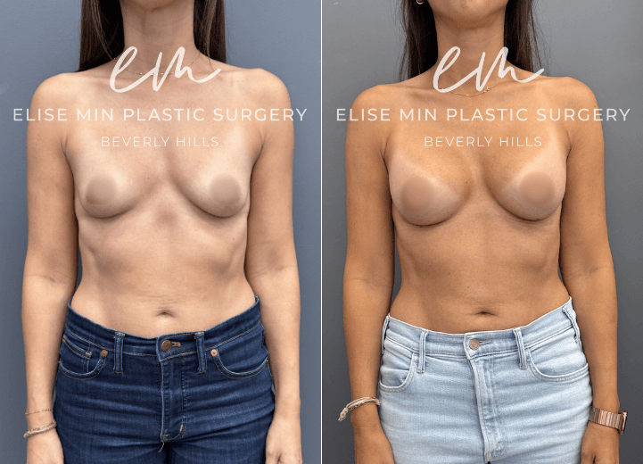 Breast augmentation with Motiva Ergonomix Mini Profile 220cc silicone breast implants - This 40-year-old patient wanted a subtle but meaningful enhancement to better complement her frame. Following breast augmentation with Motiva ERSM-220 implants, she went from an A cup to a C cup and now enjoys fuller, more balanced proportions with beautiful confidence in swimwear and everyday clothing.