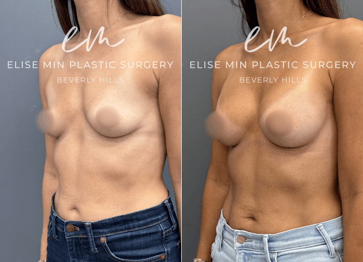 Breast augmentation with Motiva Ergonomix Mini Profile 220cc silicone breast implants - This 40-year-old patient wanted a subtle but meaningful enhancement to better complement her frame. Following breast augmentation with Motiva ERSM-220 implants, she went from an A cup to a C cup and now enjoys fuller, more balanced proportions with beautiful confidence in swimwear and everyday clothing.