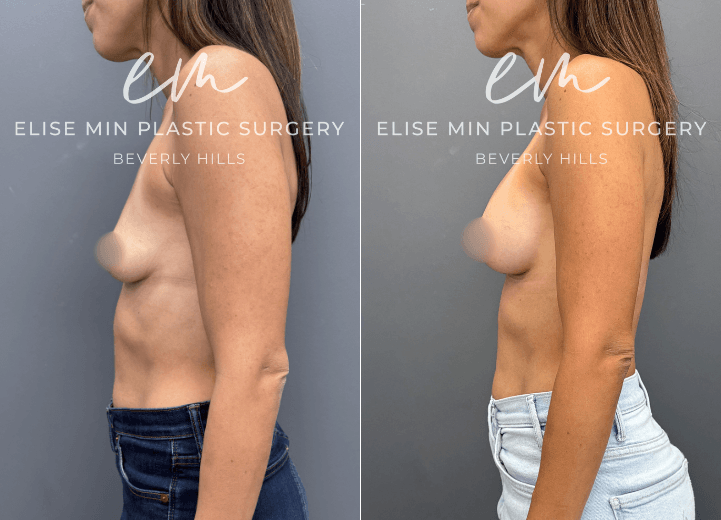 Breast augmentation with Motiva Ergonomix Mini Profile 220cc silicone breast implants - This 40-year-old patient wanted a subtle but meaningful enhancement to better complement her frame. Following breast augmentation with Motiva ERSM-220 implants, she went from an A cup to a C cup and now enjoys fuller, more balanced proportions with beautiful confidence in swimwear and everyday clothing.