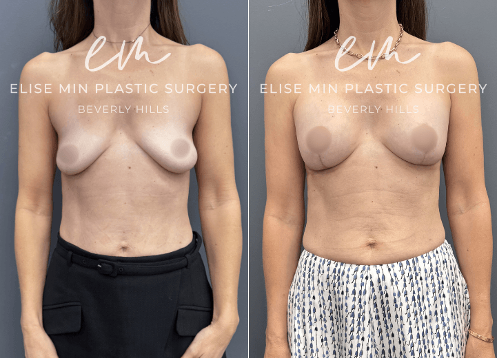 Breast Augmentation - This 47 year old woman noticed that after two pregnancies, her breasts had lost volume and upper pole fullness. She wore an A cup and desired a natural, full B cup. Her surgical plan included a breast augmentation with 185 cc Motiva implants and a breast lift guided by my MinLine™ Philosophy, an individualized approach that tailors each operation to the patient's anatomy while using the least scar necessary without compromising shape or long term support.