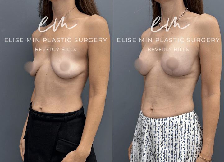 Breast Augmentation - This 47 year old woman noticed that after two pregnancies, her breasts had lost volume and upper pole fullness. She wore an A cup and desired a natural, full B cup. Her surgical plan included a breast augmentation with 185 cc Motiva implants and a breast lift guided by my MinLine™ Philosophy, an individualized approach that tailors each operation to the patient's anatomy while using the least scar necessary without compromising shape or long term support.