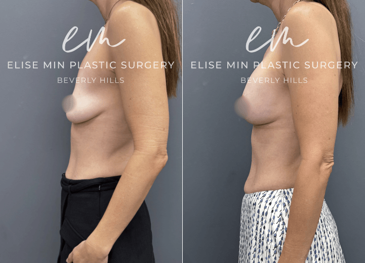 Breast Augmentation - This 47 year old woman noticed that after two pregnancies, her breasts had lost volume and upper pole fullness. She wore an A cup and desired a natural, full B cup. Her surgical plan included a breast augmentation with 185 cc Motiva implants and a breast lift guided by my MinLine™ Philosophy, an individualized approach that tailors each operation to the patient's anatomy while using the least scar necessary without compromising shape or long term support.