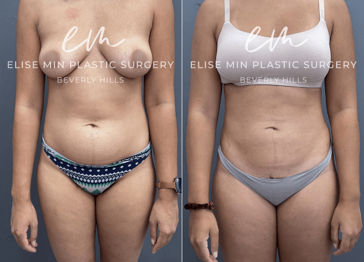 Tummy Tuck - This 29 year old woman was otherwise very happy with her body but had always been bothered by a persistent lower abdominal pouch that affected the way her clothes fit and made her feel self conscious. Despite maintaining a healthy lifestyle and exercising regularly, this area never improved to the degree she wanted. Her surgical plan included full abdominal liposuction to restore a smoother, more contoured silhouette while maintaining a natural appearance. She is thrilled with her results.