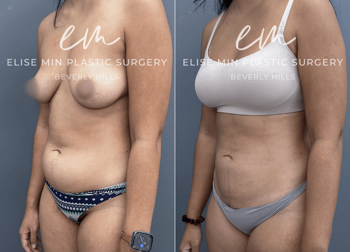 Tummy Tuck - This 29 year old woman was otherwise very happy with her body but had always been bothered by a persistent lower abdominal pouch that affected the way her clothes fit and made her feel self conscious. Despite maintaining a healthy lifestyle and exercising regularly, this area never improved to the degree she wanted. Her surgical plan included full abdominal liposuction to restore a smoother, more contoured silhouette while maintaining a natural appearance. She is thrilled with her results.