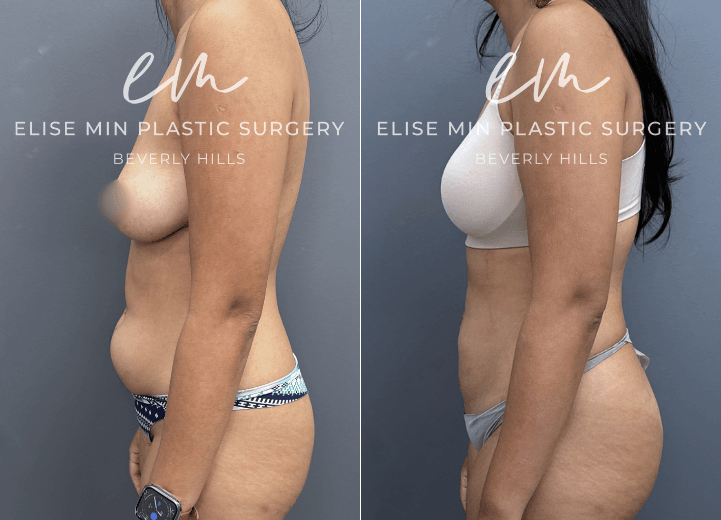 Tummy Tuck - This 29 year old woman was otherwise very happy with her body but had always been bothered by a persistent lower abdominal pouch that affected the way her clothes fit and made her feel self conscious. Despite maintaining a healthy lifestyle and exercising regularly, this area never improved to the degree she wanted. Her surgical plan included full abdominal liposuction to restore a smoother, more contoured silhouette while maintaining a natural appearance. She is thrilled with her results.