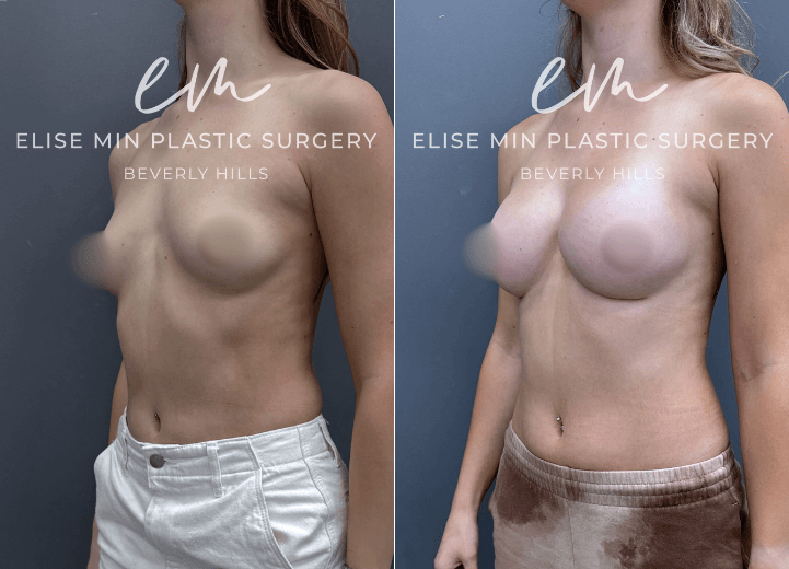 Breast Augmentation - This 30-year-old woman desired greater breast volume while maintaining a natural, feminine appearance. Her surgical plan was guided by the MinLine™ Philosophy, an individualized approach focused on creating beautiful, proportional breasts while prioritizing shape, long-term support, and safety. She underwent breast augmentation with 310cc Motiva silicone breast implants to achieve her desired enhancement while maintaining proportion to her frame.