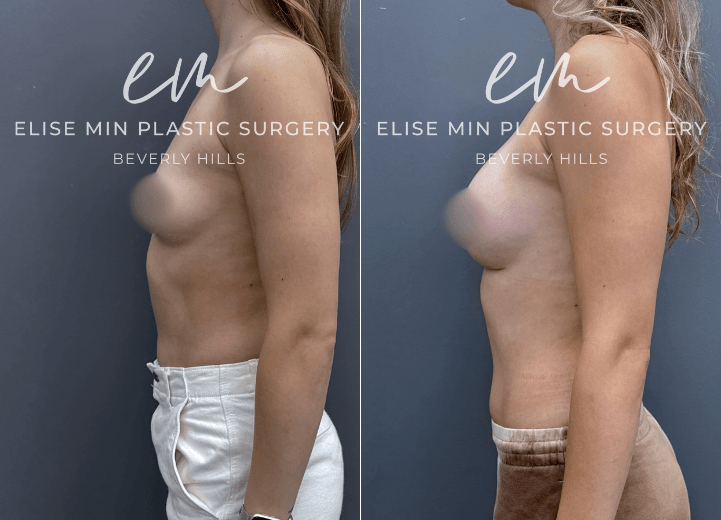 Breast Augmentation - This 30-year-old woman desired greater breast volume while maintaining a natural, feminine appearance. Her surgical plan was guided by the MinLine™ Philosophy, an individualized approach focused on creating beautiful, proportional breasts while prioritizing shape, long-term support, and safety. She underwent breast augmentation with 310cc Motiva silicone breast implants to achieve her desired enhancement while maintaining proportion to her frame.