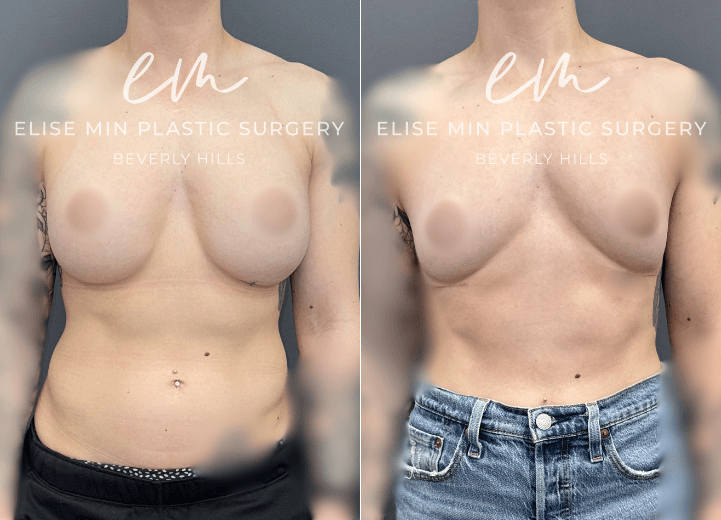 Breast Implant Removal - This 31-year-old woman previously underwent breast augmentation with another surgeon and subsequently desired implant removal because she felt her implants sat too low. Her surgical plan was guided by the MinLine™ Philosophy, an individualized approach focused on creating balanced, natural-looking breasts while prioritizing shape, long-term support, and safety. She underwent implant removal with liposuction of the lower abdomen, flanks, and medial thighs with transfer of the harvested fat to the breasts for volume and symmetry. A total of 111cc of fat was placed in the right breast and 105cc in the left.