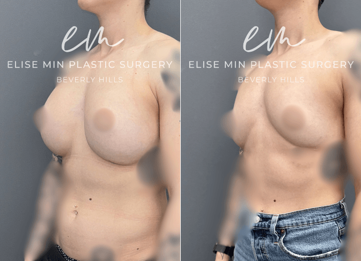 Breast Implant Removal - This 31-year-old woman previously underwent breast augmentation with another surgeon and subsequently desired implant removal because she felt her implants sat too low. Her surgical plan was guided by the MinLine™ Philosophy, an individualized approach focused on creating balanced, natural-looking breasts while prioritizing shape, long-term support, and safety. She underwent implant removal with liposuction of the lower abdomen, flanks, and medial thighs with transfer of the harvested fat to the breasts for volume and symmetry. A total of 111cc of fat was placed in the right breast and 105cc in the left.