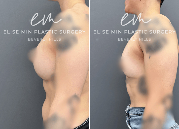Breast Implant Removal - This 31-year-old woman previously underwent breast augmentation with another surgeon and subsequently desired implant removal because she felt her implants sat too low. Her surgical plan was guided by the MinLine™ Philosophy, an individualized approach focused on creating balanced, natural-looking breasts while prioritizing shape, long-term support, and safety. She underwent implant removal with liposuction of the lower abdomen, flanks, and medial thighs with transfer of the harvested fat to the breasts for volume and symmetry. A total of 111cc of fat was placed in the right breast and 105cc in the left.