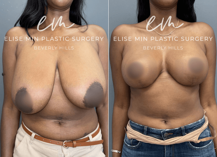 Breast Reduction - This 33 year-old woman wanted to feel more proportional to her frame while maintaining a feminine breast shape. Guided by the MinLine™ Philosophy, her individualized surgical plan focused on creating beautiful, proportional breasts with the least scar necessary without compromising shape, long-term support, or safety. She underwent an L-scar pattern breast reduction with liposuction of the surrounding tissue to optimize contour, with 461g removed from the left breast and 474g from the right. The result is a feminine, balanced breast shape that is more proportionate to her frame.