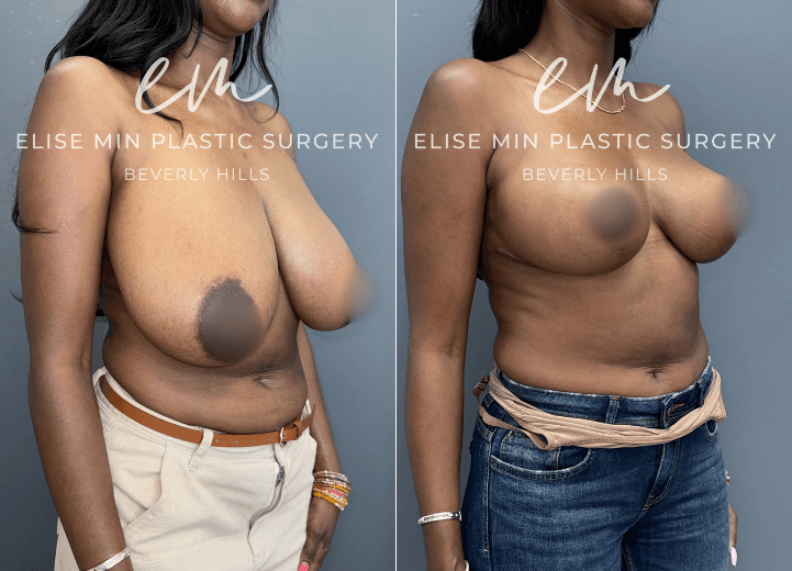 Breast Reduction - This 33 year-old woman wanted to feel more proportional to her frame while maintaining a feminine breast shape. Guided by the MinLine™ Philosophy, her individualized surgical plan focused on creating beautiful, proportional breasts with the least scar necessary without compromising shape, long-term support, or safety. She underwent an L-scar pattern breast reduction with liposuction of the surrounding tissue to optimize contour, with 461g removed from the left breast and 474g from the right. The result is a feminine, balanced breast shape that is more proportionate to her frame.