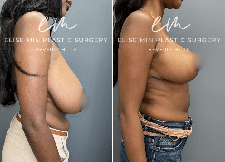 Breast Reduction - This 33 year-old woman wanted to feel more proportional to her frame while maintaining a feminine breast shape. Guided by the MinLine™ Philosophy, her individualized surgical plan focused on creating beautiful, proportional breasts with the least scar necessary without compromising shape, long-term support, or safety. She underwent an L-scar pattern breast reduction with liposuction of the surrounding tissue to optimize contour, with 461g removed from the left breast and 474g from the right. The result is a feminine, balanced breast shape that is more proportionate to her frame.