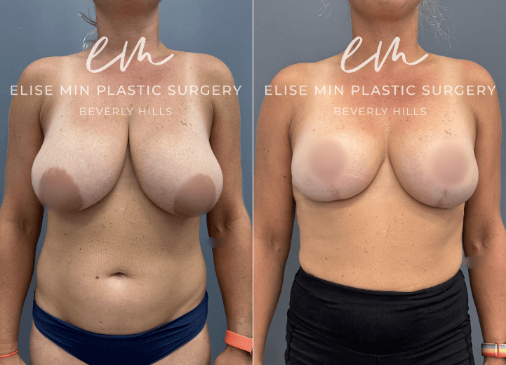 Breast Reduction - Seeking a smaller, more proportionate breast size, this 42 year-old woman wanted to transition from a 34G to a C cup while preserving a feminine, natural-looking shape. Her breast reduction was designed according to the MinLine™ Philosophy, using an individualized approach to achieve balanced proportions with the least scar necessary while prioritizing long-term support and safety. For her anatomy and goals, an L-shaped scar pattern was selected, with 270g of tissue removed from the left breast and 255g from the right. The result is a lighter, more balanced breast shape that complements her frame while maintaining the natural femininity she desired.