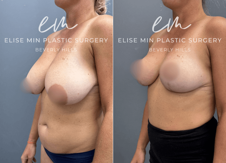 Breast Reduction - Seeking a smaller, more proportionate breast size, this 42 year-old woman wanted to transition from a 34G to a C cup while preserving a feminine, natural-looking shape. Her breast reduction was designed according to the MinLine™ Philosophy, using an individualized approach to achieve balanced proportions with the least scar necessary while prioritizing long-term support and safety. For her anatomy and goals, an L-shaped scar pattern was selected, with 270g of tissue removed from the left breast and 255g from the right. The result is a lighter, more balanced breast shape that complements her frame while maintaining the natural femininity she desired.