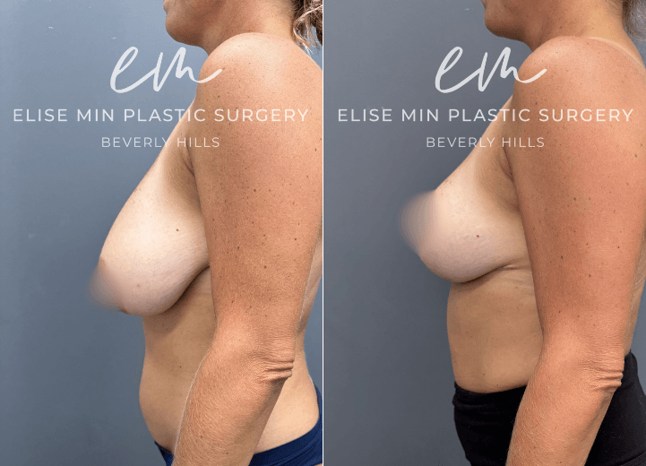 Breast Reduction - Seeking a smaller, more proportionate breast size, this 42 year-old woman wanted to transition from a 34G to a C cup while preserving a feminine, natural-looking shape. Her breast reduction was designed according to the MinLine™ Philosophy, using an individualized approach to achieve balanced proportions with the least scar necessary while prioritizing long-term support and safety. For her anatomy and goals, an L-shaped scar pattern was selected, with 270g of tissue removed from the left breast and 255g from the right. The result is a lighter, more balanced breast shape that complements her frame while maintaining the natural femininity she desired.