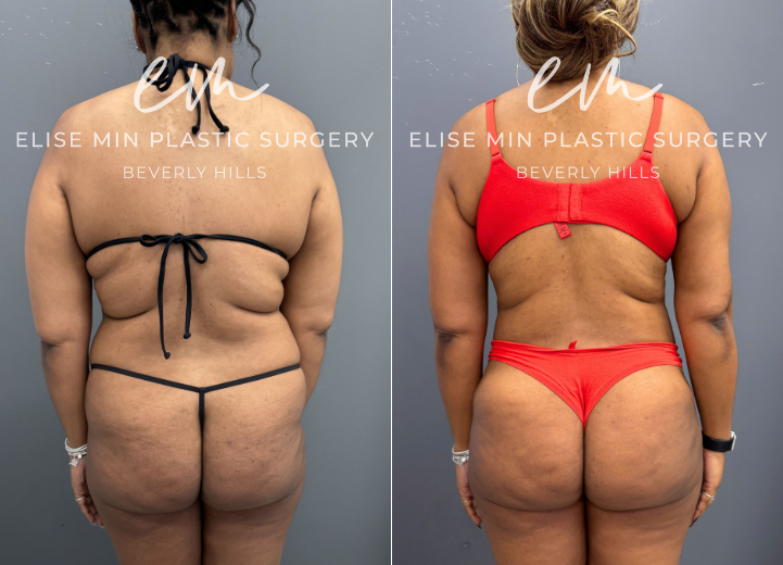 This 35-year-old patient achieved her goal weight with the assistance of tirzepatide but continued to be concerned about residual adiposity of the abdomen and flanks. During consultation, we discussed her aesthetic goals and determined that a more comprehensive contouring approach would provide the most balanced result. She underwent 3-dimensional liposuction of the torso with conservative fat grafting to the hip dips to enhance natural proportions and create smooth, balanced contours. Her outcome reflects a refined silhouette that aligns with both her weight-loss success and her aesthetic objectives. She feels beach ready with her girlfriends!