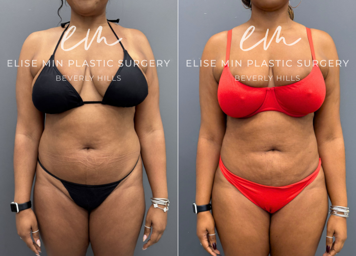 This 35-year-old patient achieved her goal weight with the assistance of tirzepatide but continued to be concerned about residual adiposity of the abdomen and flanks. During consultation, we discussed her aesthetic goals and determined that a more comprehensive contouring approach would provide the most balanced result. She underwent 3-dimensional liposuction of the torso with conservative fat grafting to the hip dips to enhance natural proportions and create smooth, balanced contours. Her outcome reflects a refined silhouette that aligns with both her weight-loss success and her aesthetic objectives. She feels beach ready with her girlfriends!