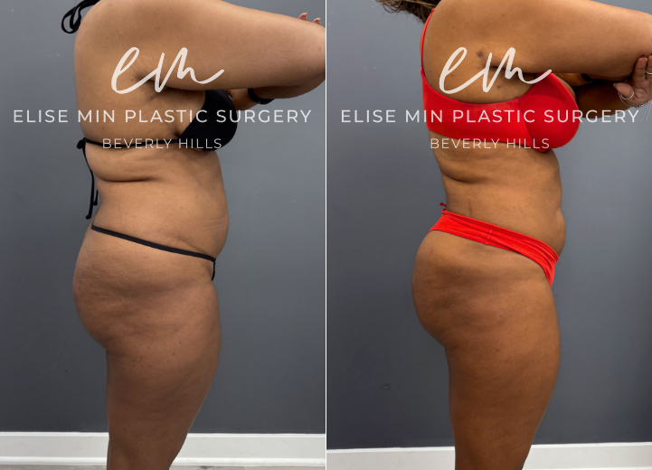 This 35-year-old patient achieved her goal weight with the assistance of tirzepatide but continued to be concerned about residual adiposity of the abdomen and flanks. During consultation, we discussed her aesthetic goals and determined that a more comprehensive contouring approach would provide the most balanced result. She underwent 3-dimensional liposuction of the torso with conservative fat grafting to the hip dips to enhance natural proportions and create smooth, balanced contours. Her outcome reflects a refined silhouette that aligns with both her weight-loss success and her aesthetic objectives. She feels beach ready with her girlfriends!