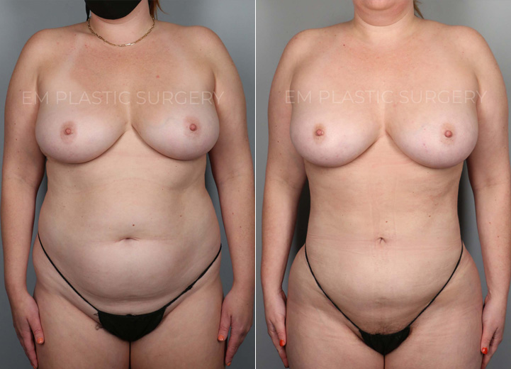 This is a 35-year-old woman who had long been desiring a natural, slimmer torso. She was at a
stable weight and decided to take the plunge towards a slimmer waistline. She underwent a 3-
dimensional body liposuction and gentle fat transfer to the hip dips on both sides to regain
confidence.