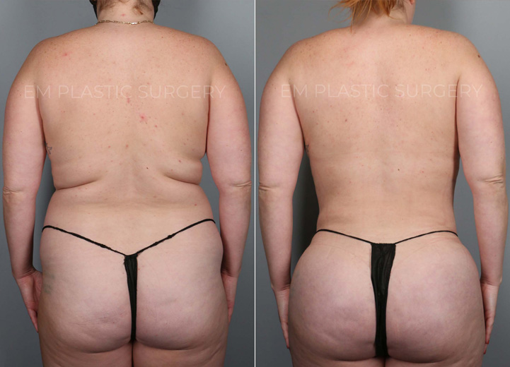 This is a 35-year-old woman who had long been desiring a natural, slimmer torso. She was at a
stable weight and decided to take the plunge towards a slimmer waistline. She underwent a 3-
dimensional body liposuction and gentle fat transfer to the hip dips on both sides to regain
confidence.