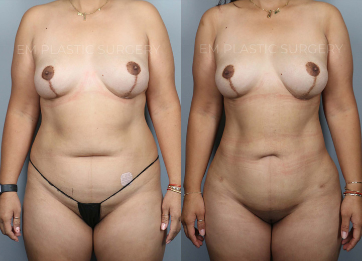 This is an energetic 43-year-old mom who felt that the stubborn fat around her abdomen and torso was impossible to lose, no matter how much she tried to exercise and diet. She initially thought liposuction of the abdomen was what she wanted. After our discussion, it was clear that the patient wanted to feel confident about her body, and in order to achieve her desired look, she needed 3-dimensional body liposuction and gentle fat transfer to the hip dips on both sides to create natural, feminine curves. She and her husband have now booked many beach trips ahead to show off her new look!
