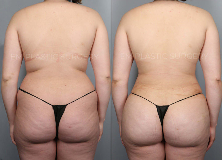 This lovely 21-year-old woman underwent liposuction of her abdomen, flanks and back along with gentle fat transfer to her hip dips and her buttocks. The goal was not to increase her buttock size since she was quite satisfied with her natural buttocks. The combination of both liposuction and gentle fat transfer was to create a balanced shape of her torso that accentuates her natural, feminine curve. She had to buy a whole new wardrobe after the procedure but she was absolutely thrilled to be doing so.