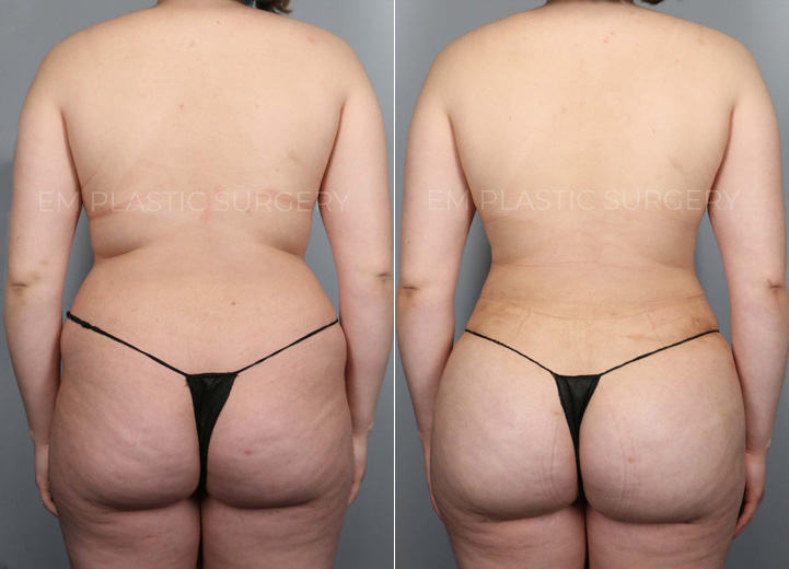 Brazilian Butt Lift Before & After Photo Gallery