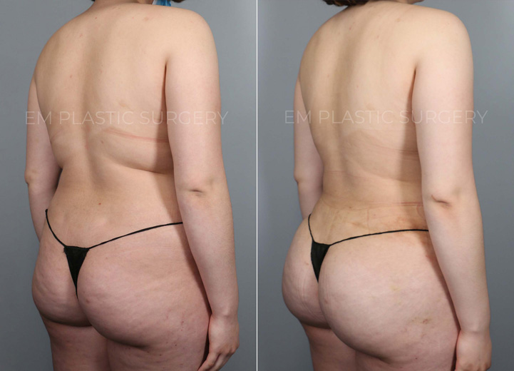 This lovely 21-year-old woman underwent liposuction of her abdomen, flanks and back along with gentle fat transfer to her hip dips and her buttocks. The goal was not to increase her buttock size since she was quite satisfied with her natural buttocks. The combination of both liposuction and gentle fat transfer was to create a balanced shape of her torso that accentuates her natural, feminine curve. She had to buy a whole new wardrobe after the procedure but she was absolutely thrilled to be doing so.