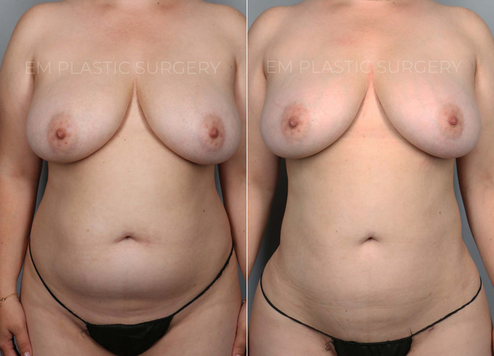 This is a 35-year-old woman with a busy work schedule, splitting her time between two cities. Her focus on work over the years has made it difficult for her to lose weight, and even when she was able to, she always carried persistent fat in her torso. She underwent liposuction of her abdomen, back, and flanks, and had gentle fat transfer to her hip dips and buttocks to reveal the natural, beautiful curve she had hidden. Going back to work, she felt more confident than ever.