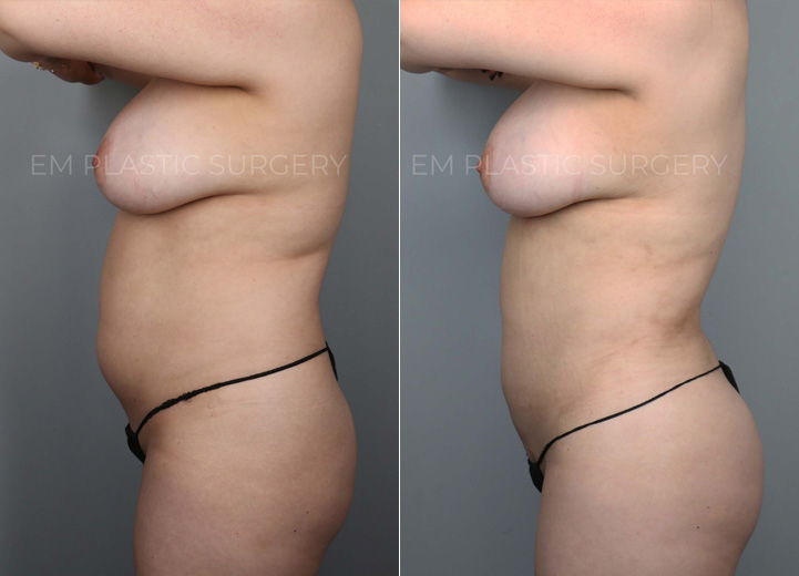 This is a 35-year-old woman with a busy work schedule, splitting her time between two cities. Her focus on work over the years has made it difficult for her to lose weight, and even when she was able to, she always carried persistent fat in her torso. She underwent liposuction of her abdomen, back, and flanks, and had gentle fat transfer to her hip dips and buttocks to reveal the natural, beautiful curve she had hidden. Going back to work, she felt more confident than ever.