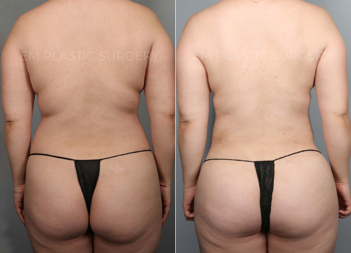 This is a 35-year-old woman with a busy work schedule, splitting her time between two cities. Her focus on work over the years has made it difficult for her to lose weight, and even when she was able to, she always carried persistent fat in her torso. She underwent liposuction of her abdomen, back, and flanks, and had gentle fat transfer to her hip dips and buttocks to reveal the natural, beautiful curve she had hidden. Going back to work, she felt more confident than ever.