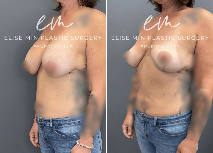 Breast Implant Removal - This woman previously underwent breast augmentation in 2011 and desired implant removal while maintaining natural breast volume and balance. Her surgical plan was guided by the MinLine™ Philosophy, an individualized approach focused on creating beautiful, proportional breasts while prioritizing shape, long-term support, and safety. She underwent implant removal with liposuction of the abdomen and bilateral flanks, with the fat transfer to the breasts to restore volume and improve symmetry. A total of 210cc of fat was placed in the right breast and 225cc in the left.