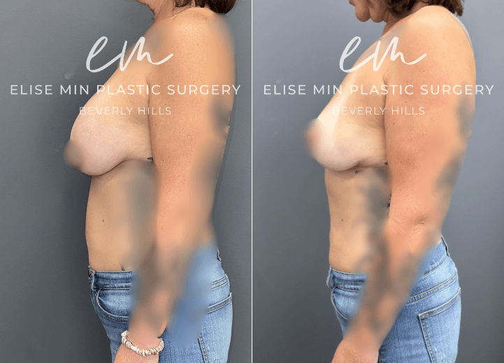 Breast Implant Removal - This woman previously underwent breast augmentation in 2011 and desired implant removal while maintaining natural breast volume and balance. Her surgical plan was guided by the MinLine™ Philosophy, an individualized approach focused on creating beautiful, proportional breasts while prioritizing shape, long-term support, and safety. She underwent implant removal with liposuction of the abdomen and bilateral flanks, with the fat transfer to the breasts to restore volume and improve symmetry. A total of 210cc of fat was placed in the right breast and 225cc in the left.