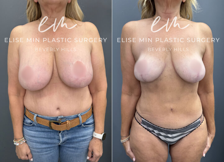 Bilateral breast implant removal, fat transfer to bilateral breasts, secondary breast reduction - This 58-year-old woman previously underwent a breast reduction at age 19 and later had breast implants placed. She came to Dr. Min seeking implant removal and a revision breast reduction to decrease her natural breast volume and achieve a lighter, more proportional appearance. Because her prior reduction was performed using an anchor-pattern incision, her existing scars were incorporated into the revision rather than creating a new scar pattern. Guided by the MinLine™ Philosophy, her individualized surgical plan focused on creating balanced, feminine breasts while prioritizing shape, long-term support, and safety. She underwent bilateral implant removal with reduction and reshaping of the remaining breast tissue, resulting in a lighter, more natural breast contour.