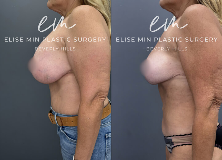 Bilateral breast implant removal, fat transfer to bilateral breasts, secondary breast reduction - This 58-year-old woman previously underwent a breast reduction at age 19 and later had breast implants placed. She came to Dr. Min seeking implant removal and a revision breast reduction to decrease her natural breast volume and achieve a lighter, more proportional appearance. Because her prior reduction was performed using an anchor-pattern incision, her existing scars were incorporated into the revision rather than creating a new scar pattern. Guided by the MinLine™ Philosophy, her individualized surgical plan focused on creating balanced, feminine breasts while prioritizing shape, long-term support, and safety. She underwent bilateral implant removal with reduction and reshaping of the remaining breast tissue, resulting in a lighter, more natural breast contour.