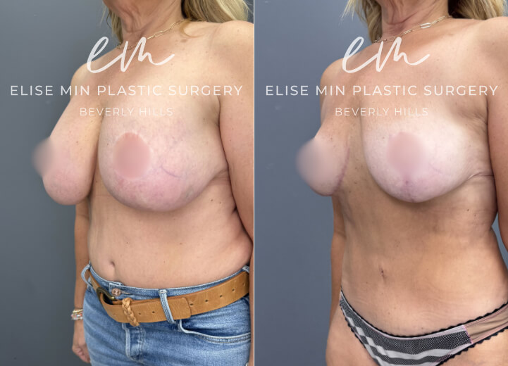 Bilateral breast implant removal, fat transfer to bilateral breasts, secondary breast reduction - This 58-year-old woman previously underwent a breast reduction at age 19 and later had breast implants placed. She came to Dr. Min seeking implant removal and a revision breast reduction to decrease her natural breast volume and achieve a lighter, more proportional appearance. Because her prior reduction was performed using an anchor-pattern incision, her existing scars were incorporated into the revision rather than creating a new scar pattern. Guided by the MinLine™ Philosophy, her individualized surgical plan focused on creating balanced, feminine breasts while prioritizing shape, long-term support, and safety. She underwent bilateral implant removal with reduction and reshaping of the remaining breast tissue, resulting in a lighter, more natural breast contour.