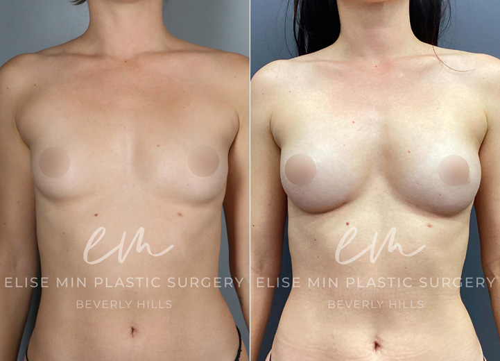 This is a 32 year-old woman who wanted a natural boost to her breasts without using any implants. She desired to go from her AA cup size to an A cup size. During the operation, she had 135cc of fat cells injected into her right breast and 88cc of fat cells into her left breast. At her six-month postoperative visit, she was thrilled with her results and couldn’t be happier. 