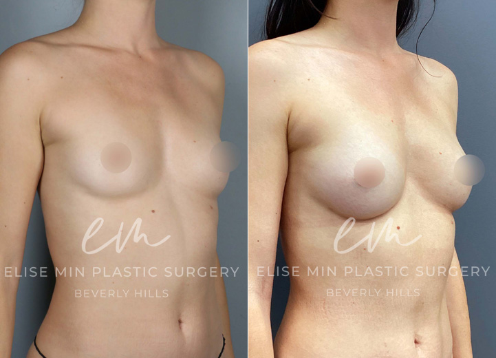 This is a 32 year-old woman who wanted a natural boost to her breasts without using any implants. She desired to go from her AA cup size to an A cup size. During the operation, she had 135cc of fat cells injected into her right breast and 88cc of fat cells into her left breast. At her six-month postoperative visit, she was thrilled with her results and couldn’t be happier. 